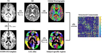 Structural network alterations in patients with nasopharyngeal carcinoma after radiotherapy: A 1-year longitudinal study